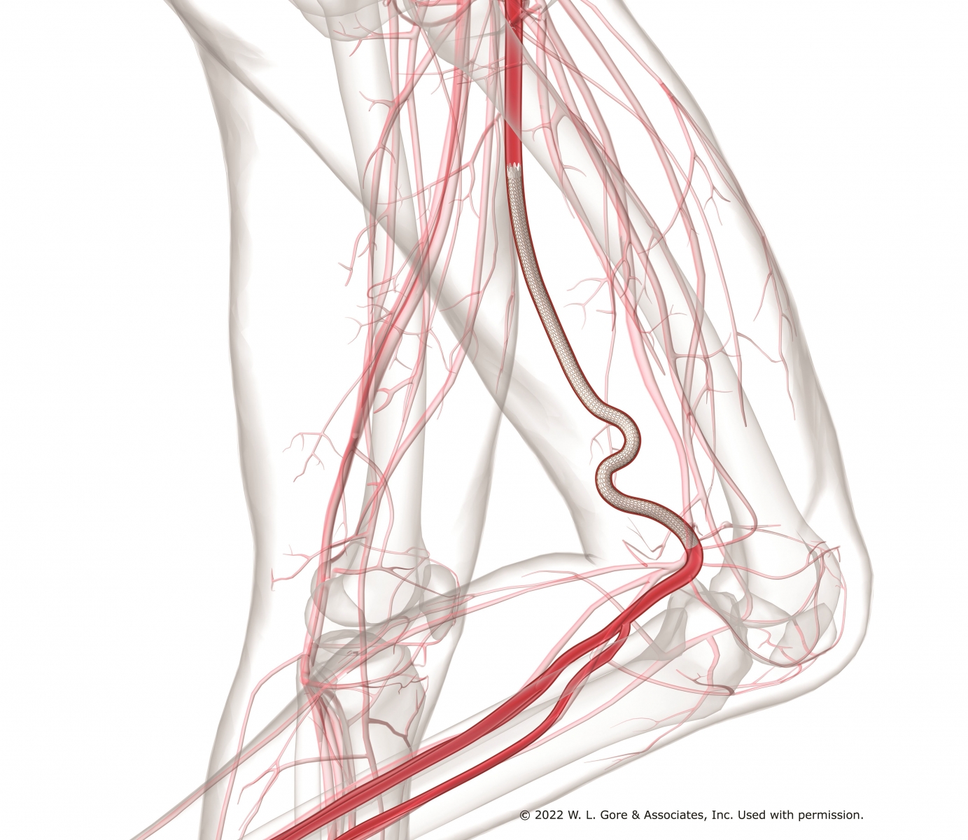 Stent-Prothese in Kniekehle